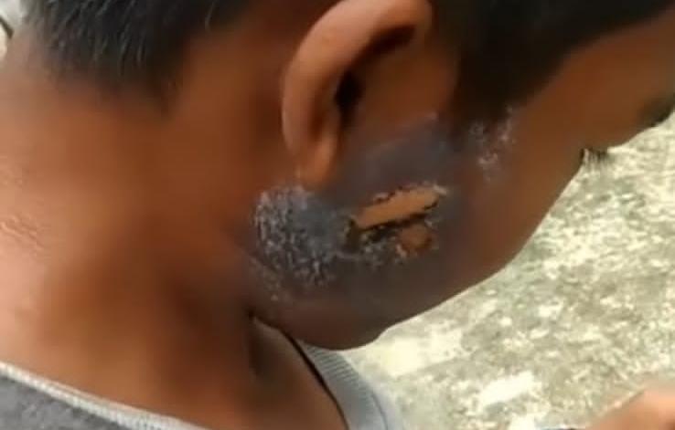 Bocah Pekanbaru yang Disiram Air Panas di Mesjid Berdamai dengan Pelaku