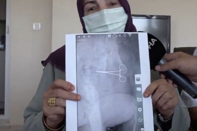 Habis Operasi, Gunting Bedah Tertinggal di Dalam Perut Perempuan Ini